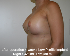 plastic-surgery-breast-augmentation